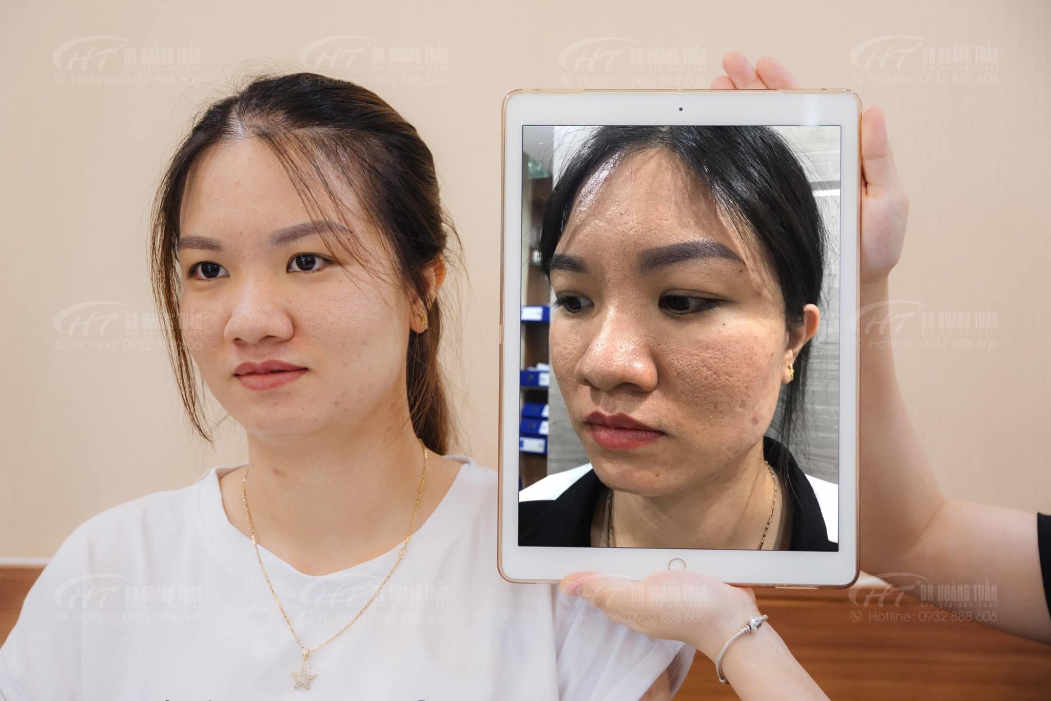 trị sẹo rỗ bằng laser có hiệu quả không